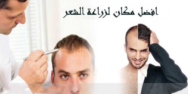 افضل مكان لزراعة الشعر