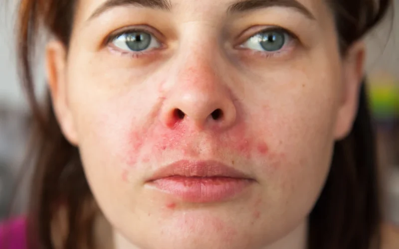 أضرار كريم كرتون على الوجه تحذير طبي هام