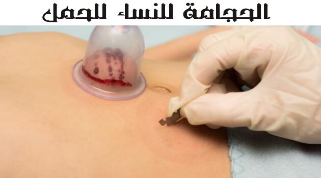 أماكن الحجامة للنساء للحمل