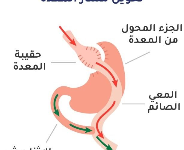 عملية تحويل المسار وتكميم المعدة تعرف عليها بالتفصيل