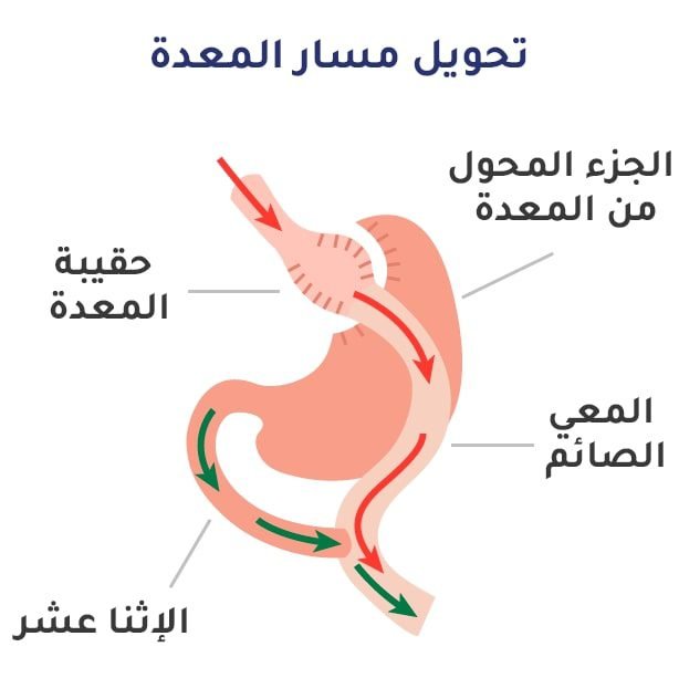 تحويل المسار وتكميم المعدة