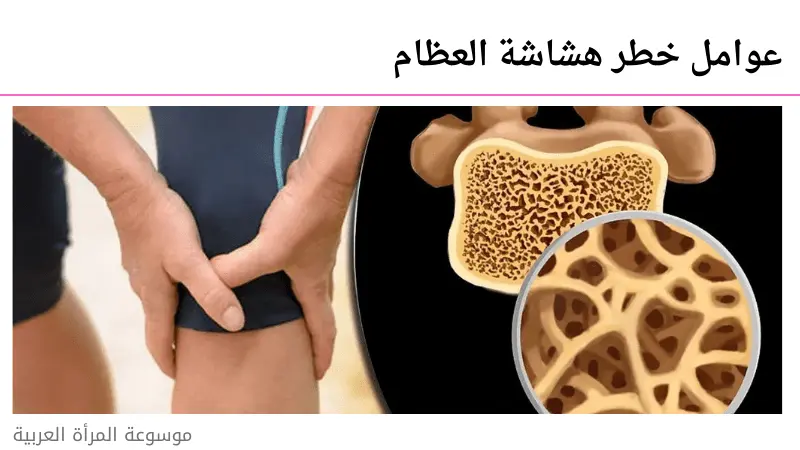 عوامل خطر هشاشة العظام