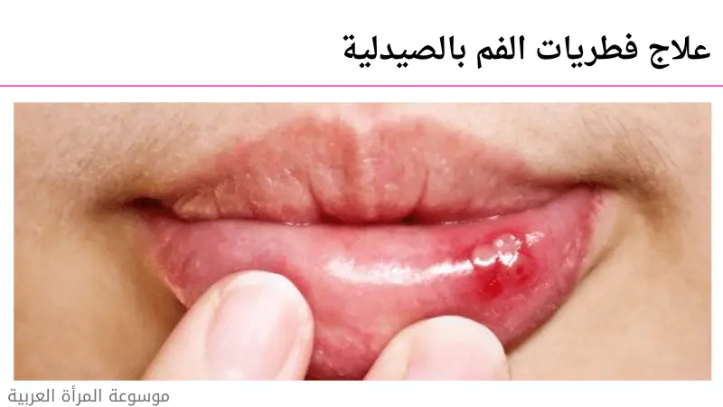 علاج فطريات الفم بالصيدلية