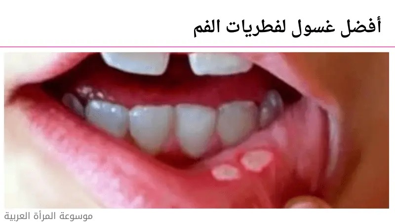 أفضل غسول لفطريات الفم