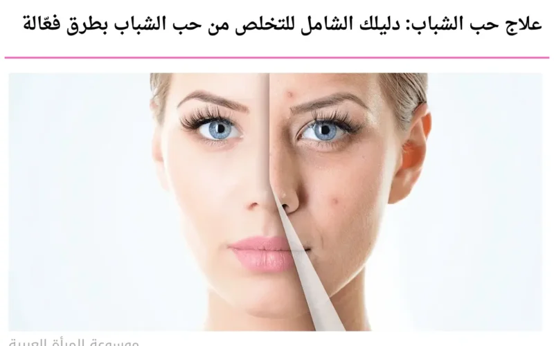 علاج حب الشباب: دليلك الشامل للتخلص من حب الشباب بطرق فعّالة